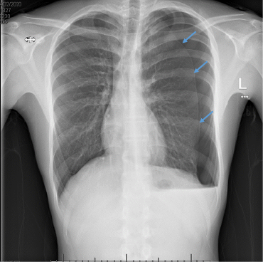 Bilateral pneumothorax