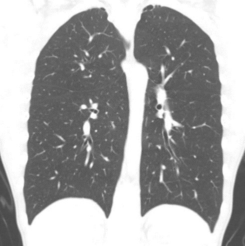 CT scan of thorax in sagittal plane showing bilateral bleb disease in a 14 year old girl who has only been symptomatic on the left. No evidence of residual pneumothorax.