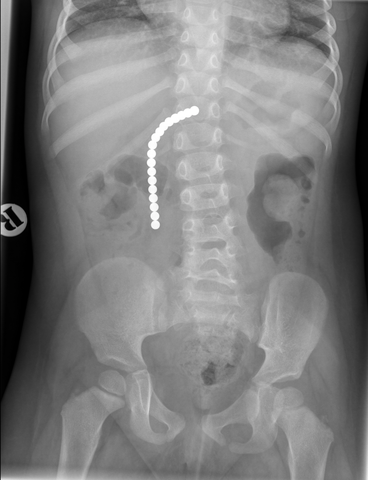 x-ray of ingested magnets